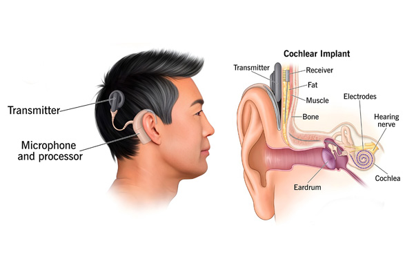 Cochlear Implants:  Benefits, Procedure, Risks, and Recovery