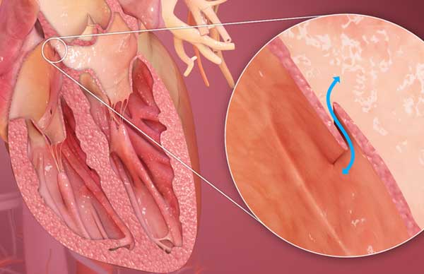 Congenital Heart Disease: Understanding Atrial Septal Defect (ASD)